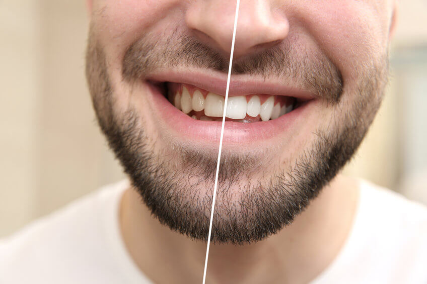 Tanden Bleken? Top 10 Beste (TIP) - Tandartswiki